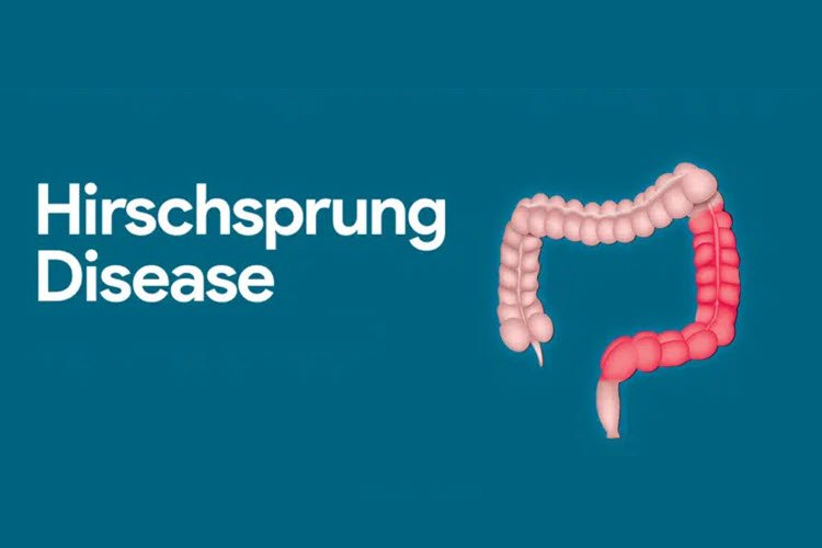 Hirschsprung Disease